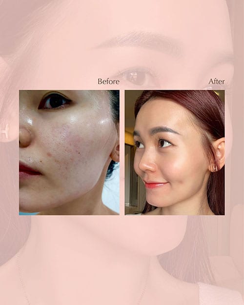 Skin transformation review by Stephy